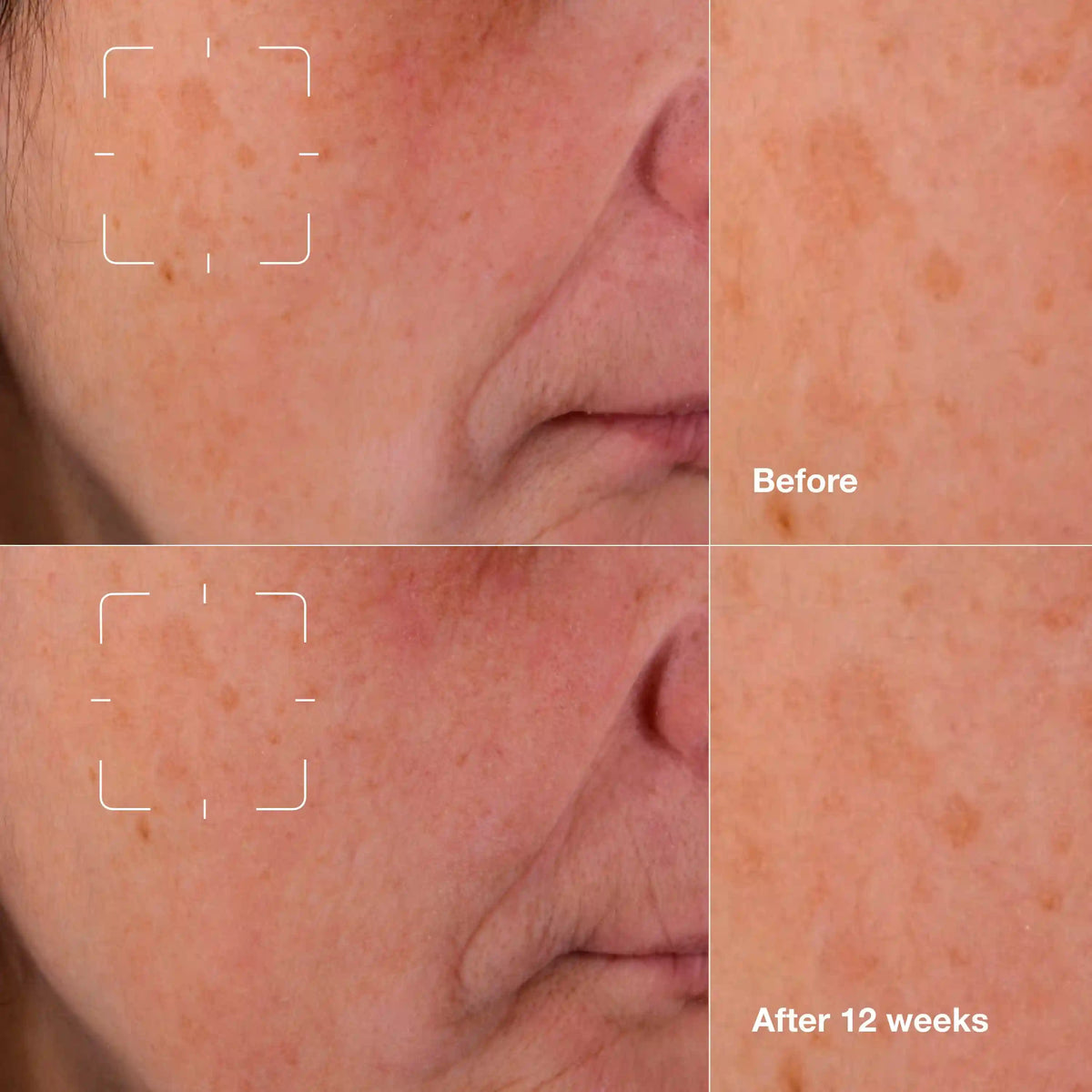 Even Better Clinical™ Dark Spot Clearing Serum